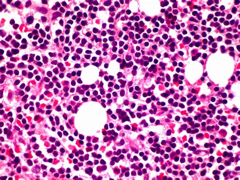 Pathology Outlines Lymphoplasmacytic Lymphoma