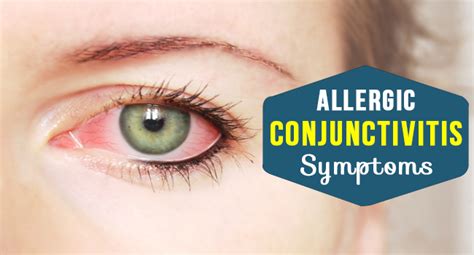 Allergic Conjunctivitis Symptoms Allergy
