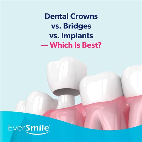 Dental Crowns Vs Bridges Vs Implants — Which Is Best