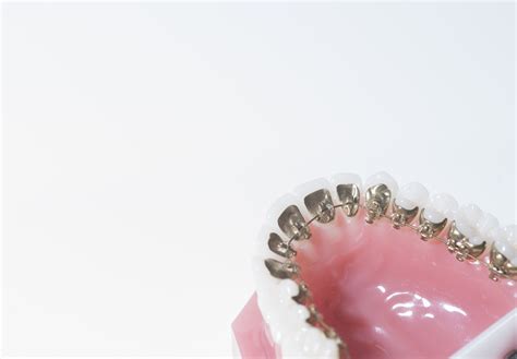 Go Incognito With Lingual Braces Belmar Orthodontics