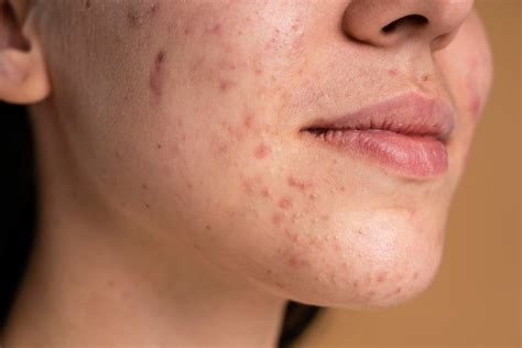Acne Scars Learn About Types And Treatments Healthwire