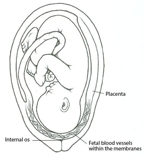 vasa previa gynecology and obstetrics merck manuals professional edition