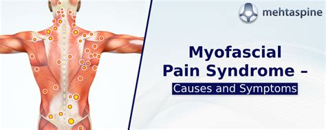 Myofascial Pain Syndrome Trigger Points Chart Syndrome Treatment