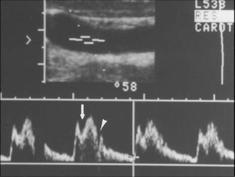 Figure 5 From A Spectrum Of Doppler Waveforms In The Carotid And
