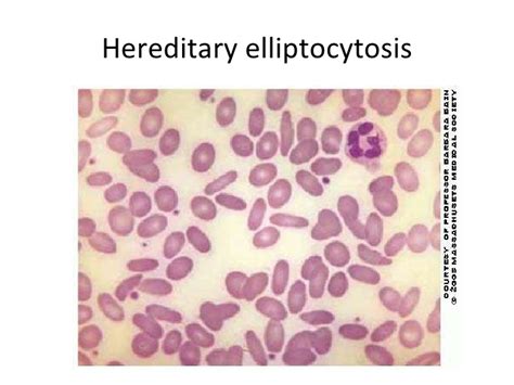 Symptoms and causes hereditary elliptocytosis prophylaxis hereditary elliptocytosis. Hereditary elliptocytosis as related to Congenital ...