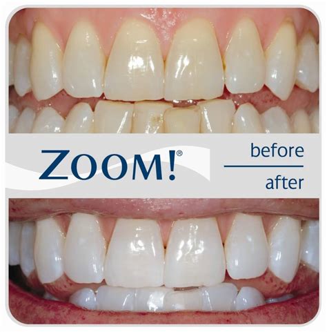 Please tell us where you read or heard it (including the quote, if possible). Zoom Teeth Whitening Costs & Reviews - The Dental Guide