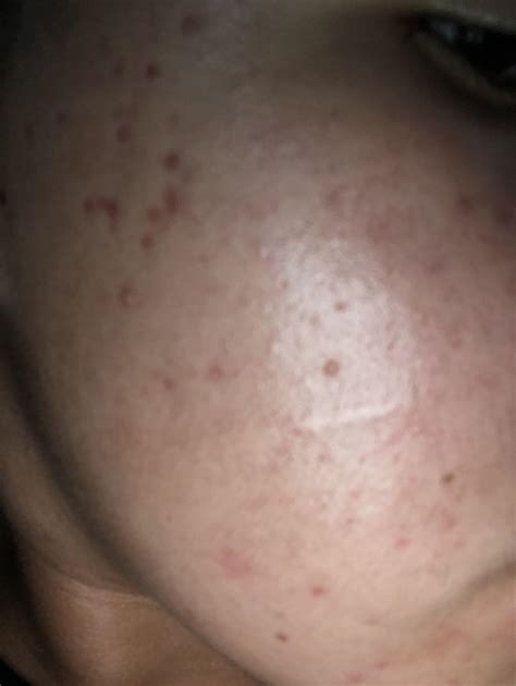 Red Dots On Face Skin Bumps That Look Like Pimples But Aren T What