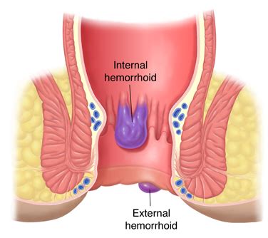 What Is A Thrombosed Hemorrhoid Symptoms Causes And Treatment