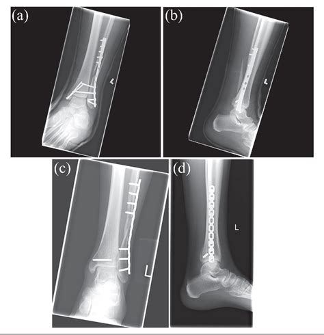 Figure From Operative Treatment Of Nonunion Following Distal Fibula And Medial Malleolar Ankle