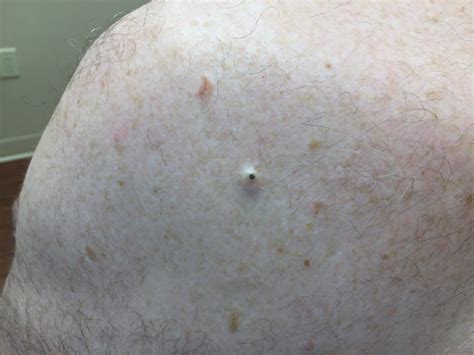Dilated Pore Of Winer Picture Causes Treatment And Prevention