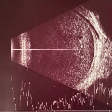 Oct Of Her Right Optic Nerve Shows Optic Nerve Atrophy With Abnormal