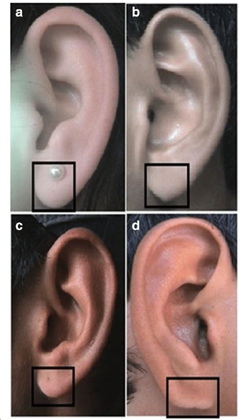 Photographs Showing The Different Shapes Of The Earlobe A Tongue B