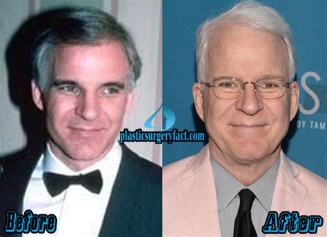 Steve Martin Plastic Surgery Before And After Photos Plastic Surgery