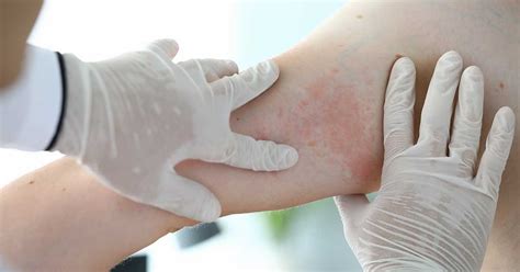 How Does Eczema Affect The Body