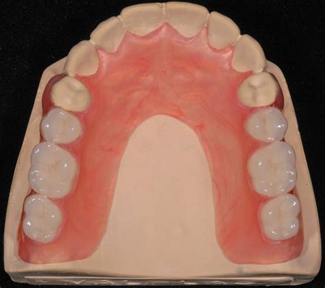 Check spelling or type a new query. Upper Valplast Flexible Partial