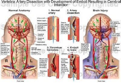 Vertebral Artery Dissection Oklahoma Chiropractors Association