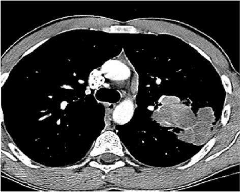 Ct Chest April 2020 Lung And Mediastinal Windows Respectively