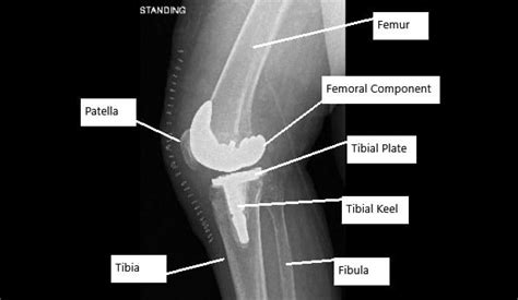 Avascular Necrosis Avn Of The Knee Complete Orthopedics