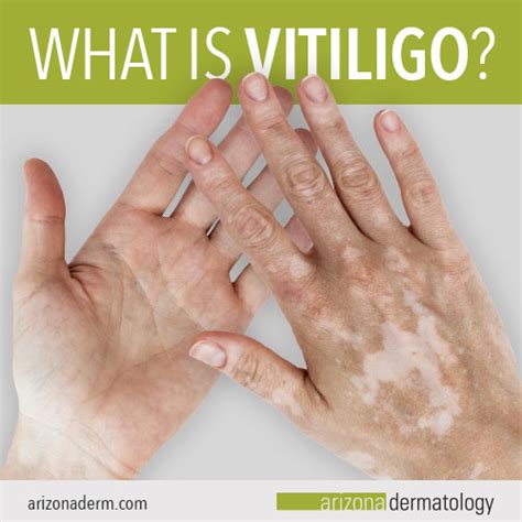 What Is Vitiligo How Can You Treat It Arizona Dermatology