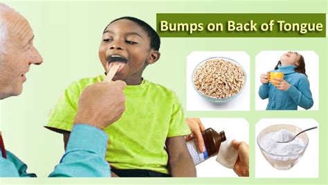 Cause And Cure Of Bumps On Back Of Tongue With Effective Home Remedies