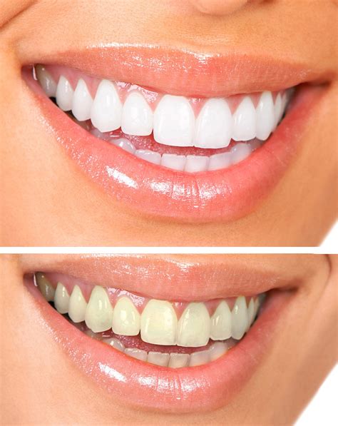 Teeth Discoloration Problems Ask Your Dentist For The Best Solution