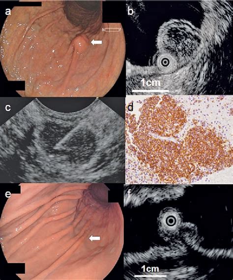 Figure 3 From Clinical Usefulness Of Endoscopic Ultrasound Guided Fine