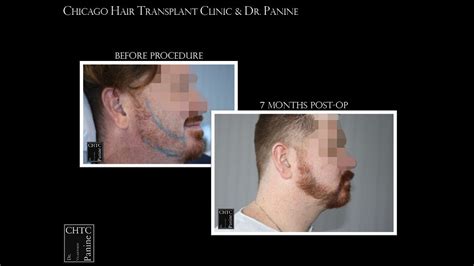 Panine Md Chicago Hair Transplant Clinic Fue Beard Transplant