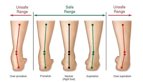 What Is Foot Pronation