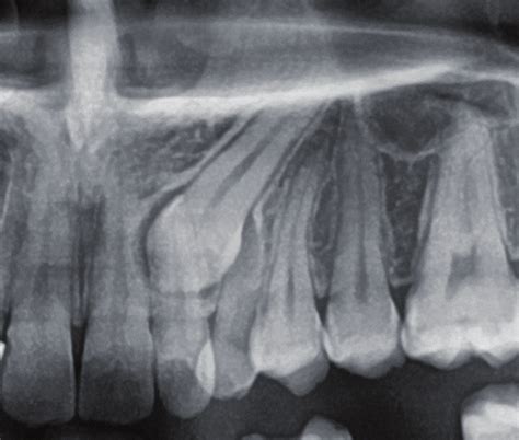 Radiograph Of Dentigerous Cyst In Maxillary Impacted Canine Download