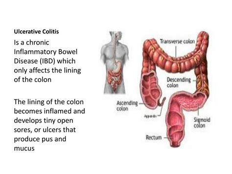 Ppt Ulcerative Colitis Powerpoint Presentation Free Download Id
