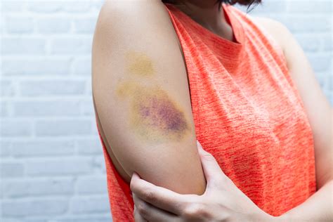 Bruises Why We Get Them Health Beat