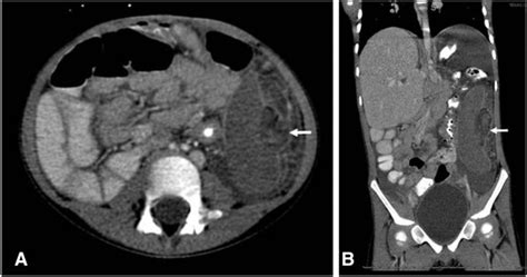 Ct Imaging Of Infarcted Spleen Aaxial Image Showing Global