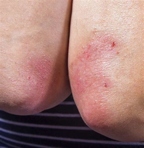 Does Psoriasis Spread Facts And How To Stop It
