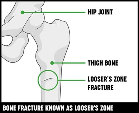 Osteomalacia Causes Symptoms Treatment Versus Arthritis