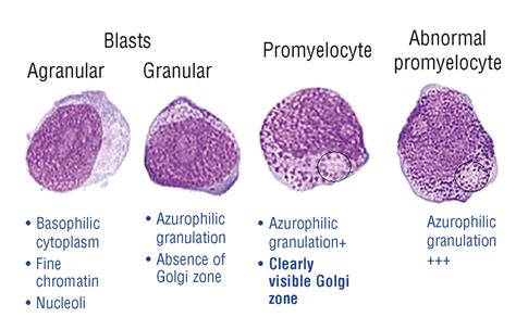 Diagnosis And Classification Of Myelodysplastic Syndrome International