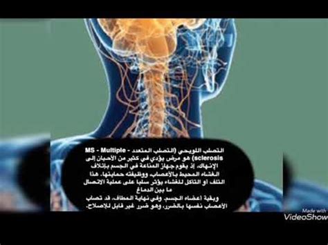 التصلب اللويحي مرض عصبي مزمن يصيب الجهاز العصبي المركزي ويؤثر على الدماغ والحبل الشوكي, ويسبب تلفًا في الغشاء المحيط بالخلايا العصبية والذي يدعى المايلين. علاج التصلب اللويحي المتعدد - YouTube