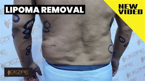 Multiple Body Lipoma Removal With Minimal Scarless By Dr Prashant