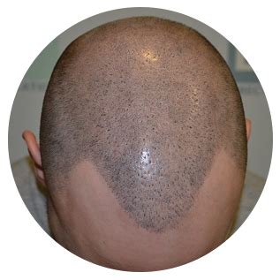 I am asking who much is the minimum living cost for an undergraduate student in malaysia if he was enjoying a scholarship? , has anybody any information that may be of help ? Hair Transplant: Hair Transplant in Kuala Lumpur, Malaysia ...