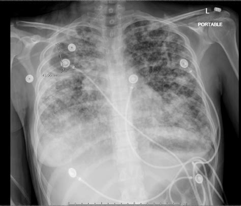 Cureus Cardiac Arrest In An Extensive Pulmonary Tuberculosis Patient