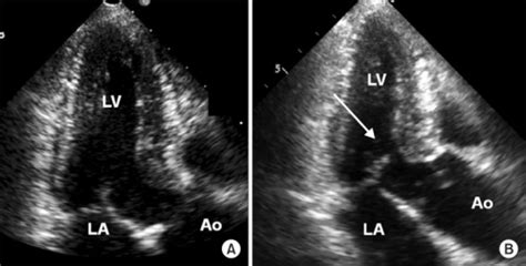 Apical 3 Chamber View Showing The Left Ventricular Lv Open I