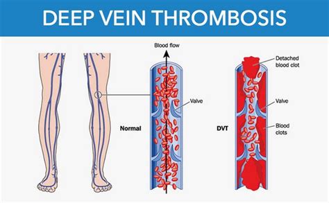 Deep Vein Thrombosis With Causes And Nursing Intervention