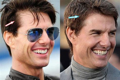 Did Tom Cruise Have Plastic Surgery Before And After Photos