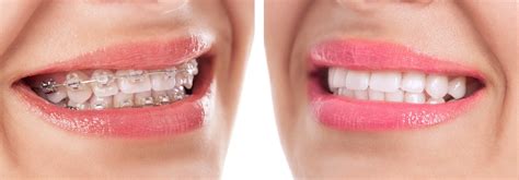 Orthodontics In Temecula Ca Choice Dental