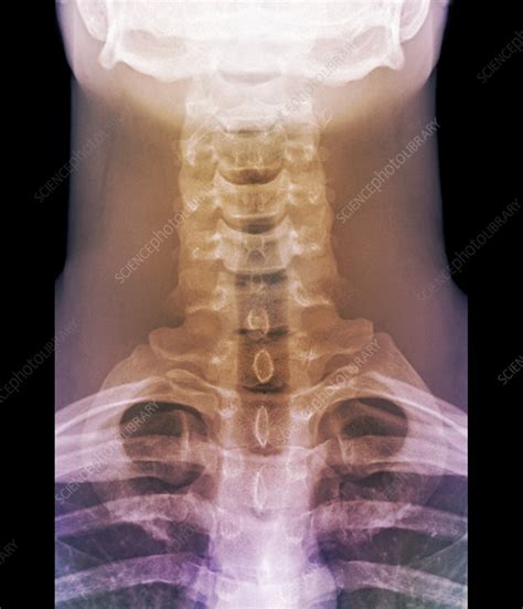 Normal Neck X Ray Stock Image F0033509 Science Photo Library