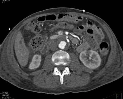 Aortic Dissection In Abdominal Aorta Following Repair Of