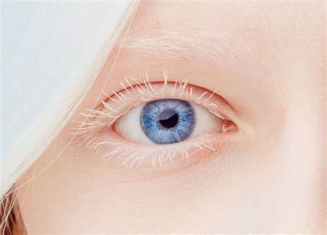 Albinismo Ocular Causas Síntomas Y Tratamiento Área Oftalmológica