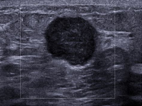 Figure 2 From Imaging Features Of Triple Negative Breast Carcinoma