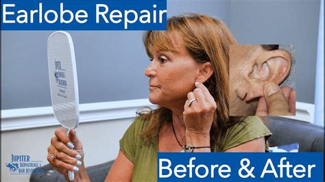 Torn Earlobe Repair Before And After Patient Testimonial Youtube