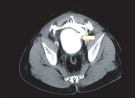 Abdominopelvic Ct Scan Showed Extravasation Of Contrast From The