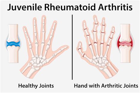 Juvenile Rheumatoid Arthritis Types Symptoms And Treatment